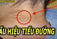 8-dau-hieu-trieu-chung-cua-benh-tieu-duong-co-the-ban-khong-biet