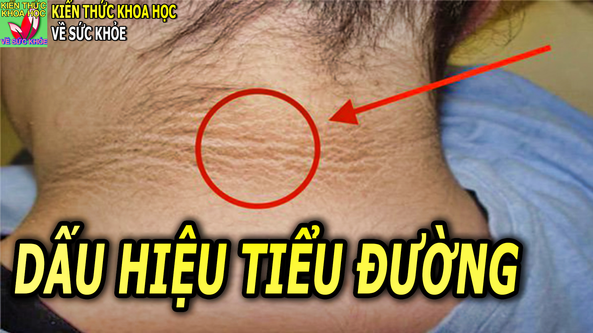 8-dau-hieu-trieu-chung-cua-benh-tieu-duong-co-the-ban-khong-biet