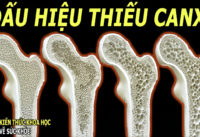 dau-hieu-bieu-hien-o-nguoi-bi-thieu-canxi
