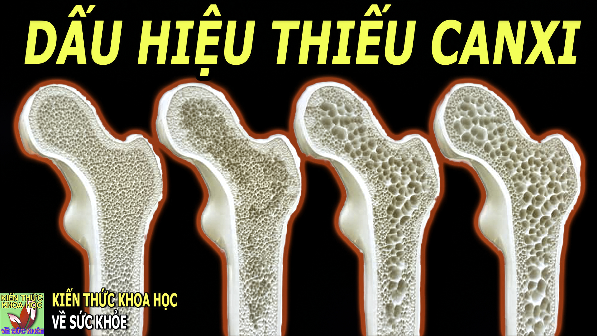 dau-hieu-bieu-hien-o-nguoi-bi-thieu-canxi