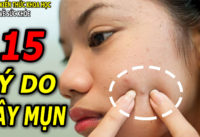 15-nguyen-nhan-gay-mun-ai-cung-nen-biet-som