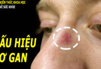 5-dau-hieu-trieu-chung-bao-hieu-suc-khoe-gan-dang-co-van-de