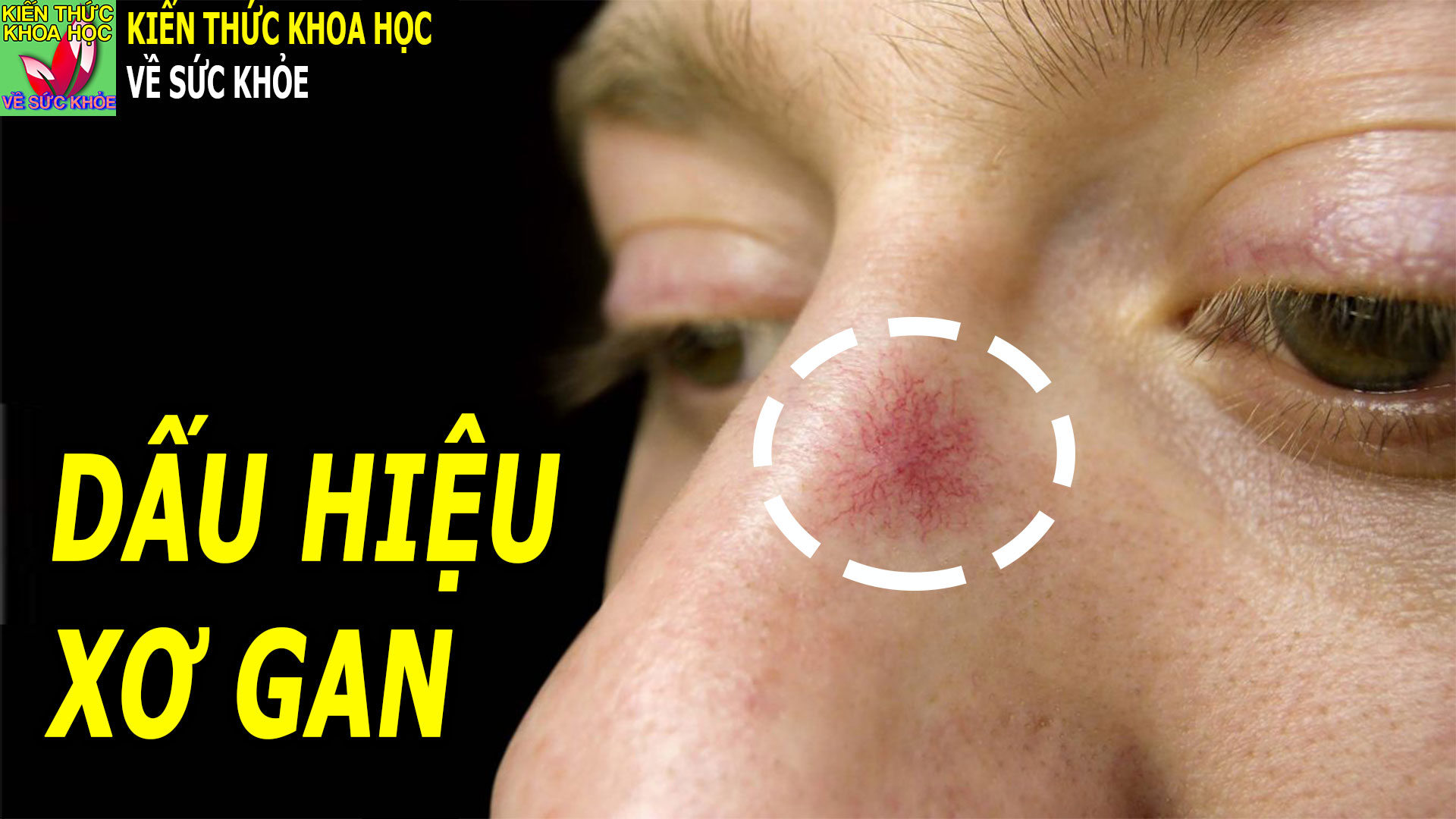 5-dau-hieu-trieu-chung-bao-hieu-suc-khoe-gan-dang-co-van-de