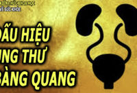 5-dau-hieu-trieu-chung-ung-thu-bang-quang-ai-cung-nen-biet-som