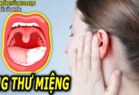 6-dau-hieu-trieu-chung-ung-thu-mieng-ai-cung-nen-biet-som