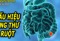 8-dau-hieu-trieu-chung-ung-thu-ruot-ai-cung-nen-biet-som