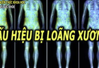 dau-hieu-trieu-chung-o-nguoi-bi-loang-xuong