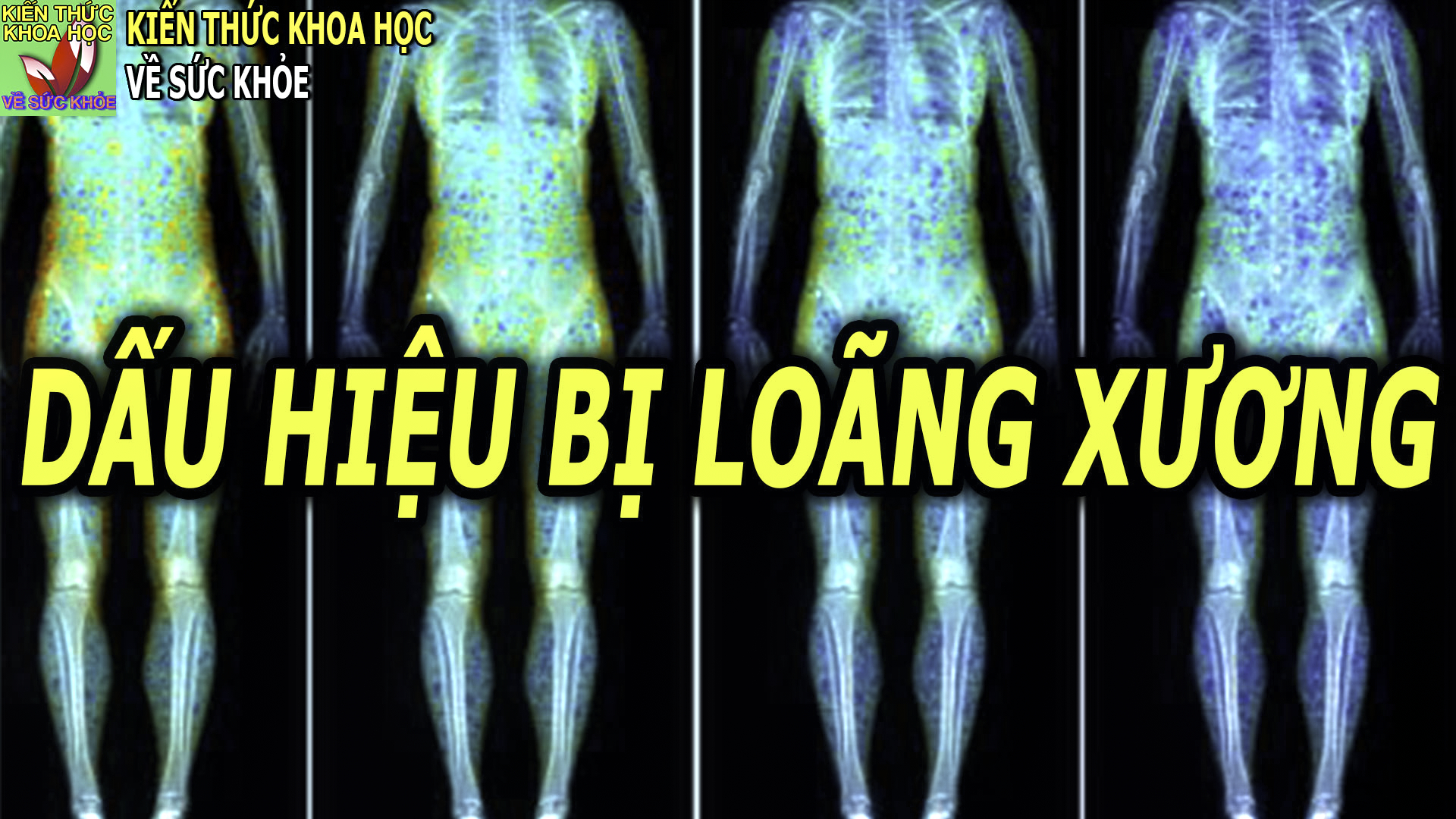 dau-hieu-trieu-chung-o-nguoi-bi-loang-xuong