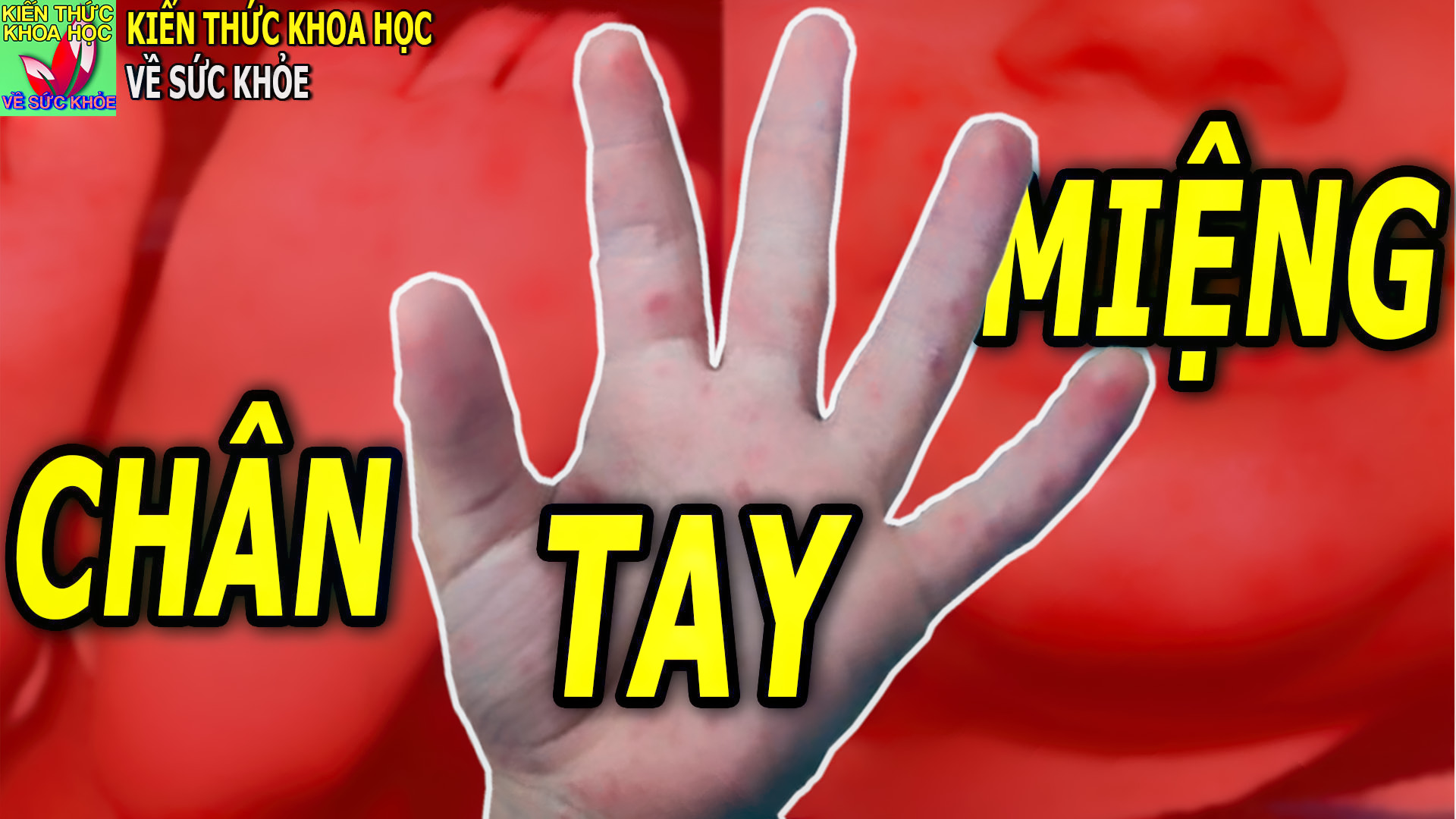 benh-tay-chan-mieng-dau-hieu-nguyen-nhan-va-cach-dieu-tri