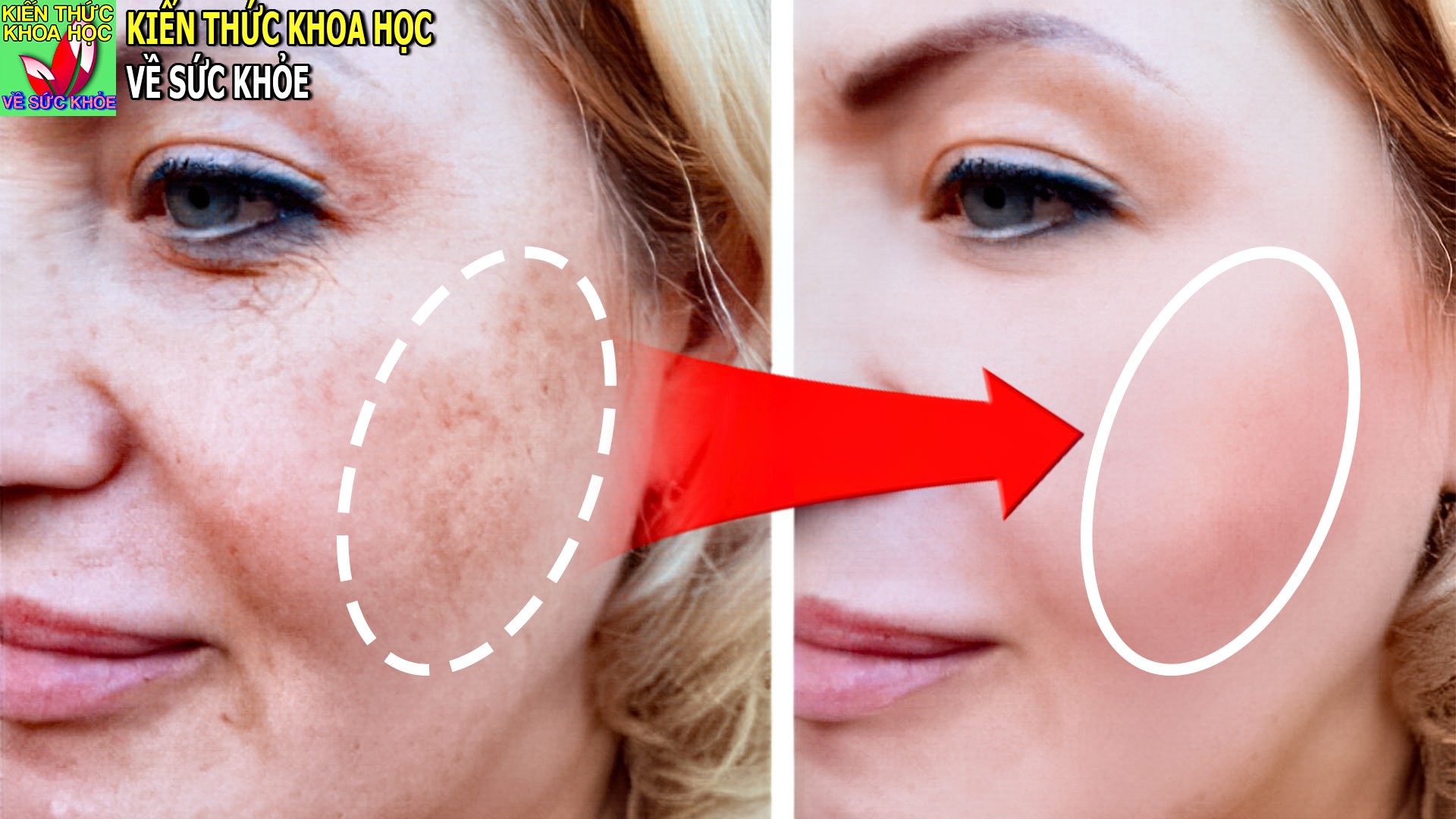 xoa-tan-nam-da-tan-nhang-mot-cach-tu-nhien-ngay-tai-nha