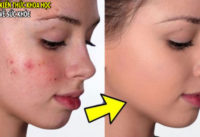 4-cach-tri-mun-trung-ca-nhanh-nhat-hoan-toan-tu-nhien