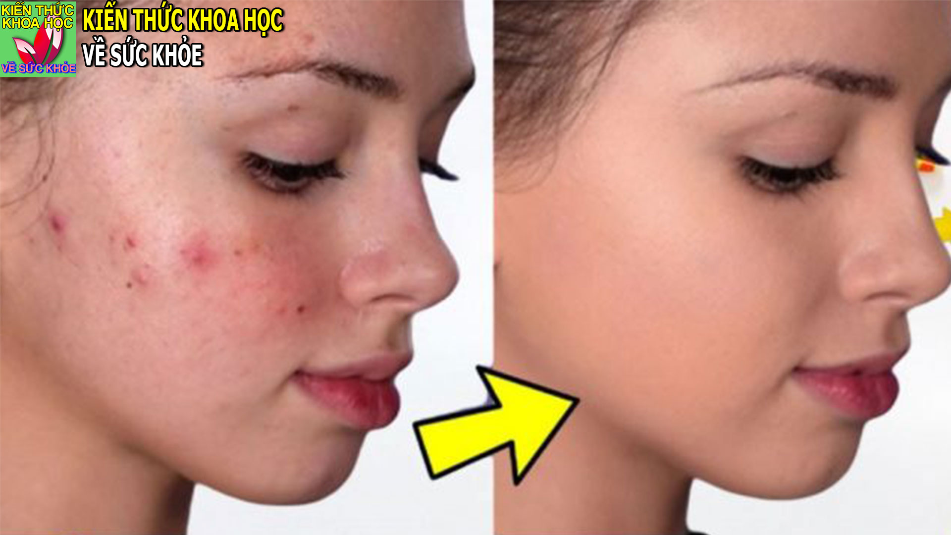 4-cach-tri-mun-trung-ca-nhanh-nhat-hoan-toan-tu-nhien