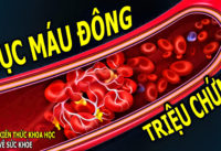 7-dau-hieu-trieu-chung-cua-cuc-mau-dong-ai-cung-nen-biet-som