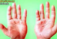 benh-a-sung-cham-kho-la-gi