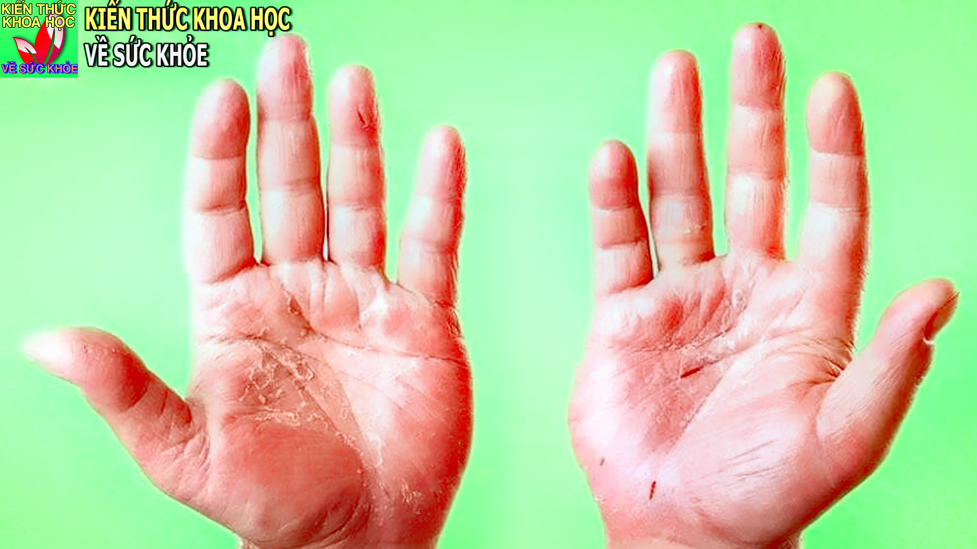 benh-a-sung-cham-kho-la-gi