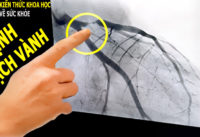 dau-hieu-nhan-biet-benh-mach-vanh