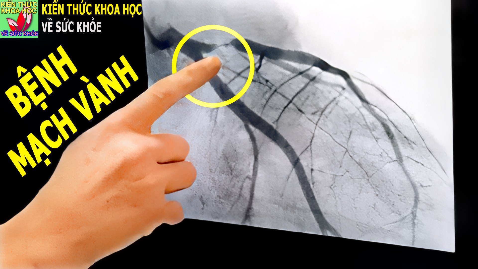 dau-hieu-nhan-biet-benh-mach-vanh