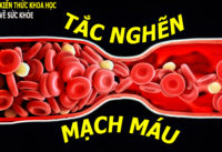 tac-nghen-mach-mau-trieu-chung-va-cach-phong-ngua