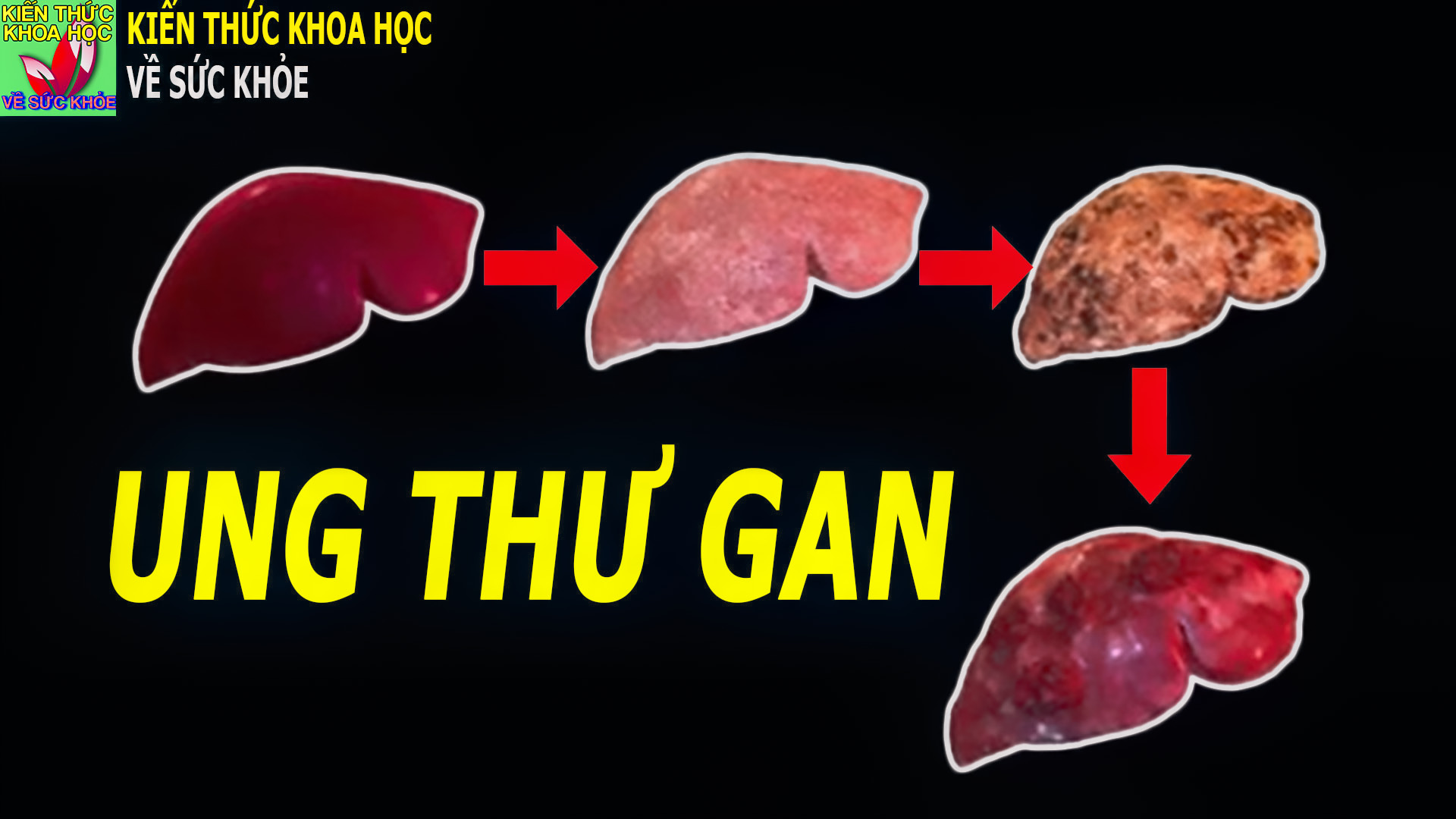 nguyen-nhan-gay-ung-thu-gan-khong-the-coi-thuong