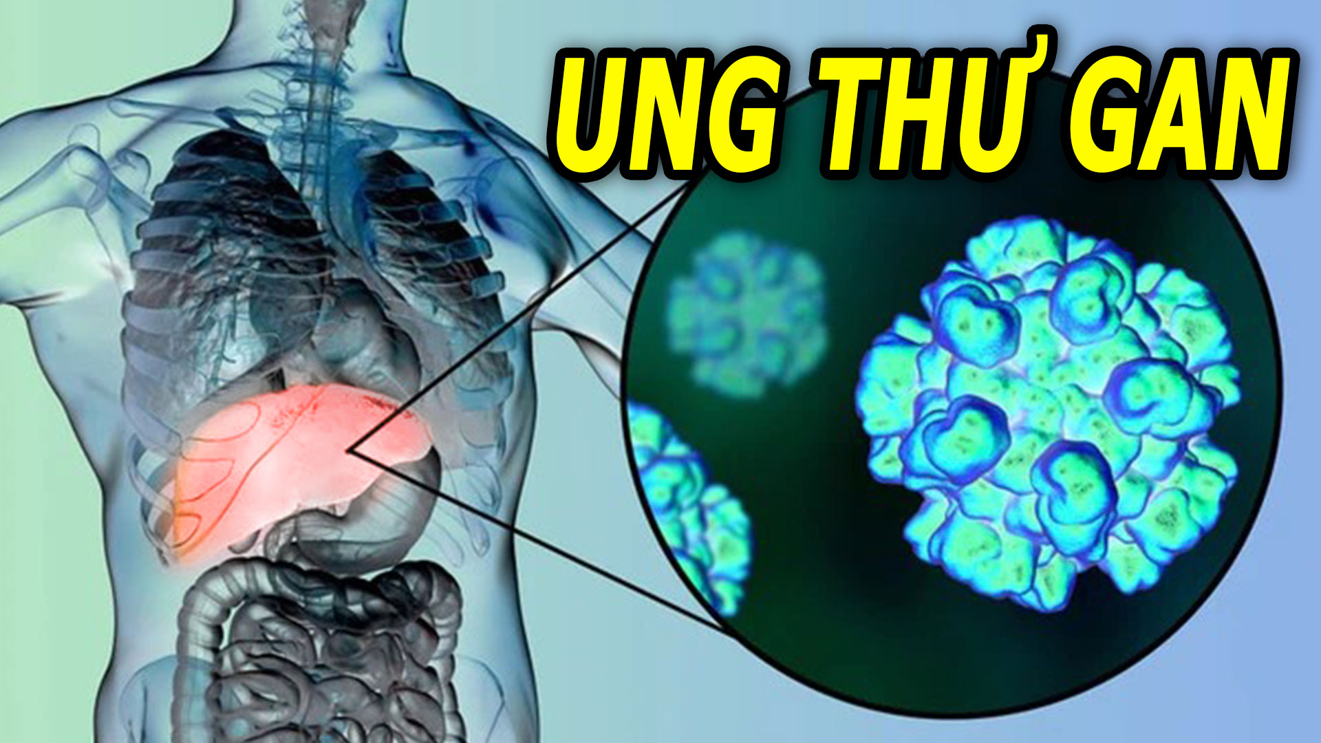 ung-thu-gan-co-the-phong-ngua-neu-biet-nhung-dieu-nay