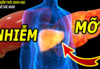 ban-ngay-co-trieu-chung-nay-coi-chung-bi-gan-nhiem-mo
