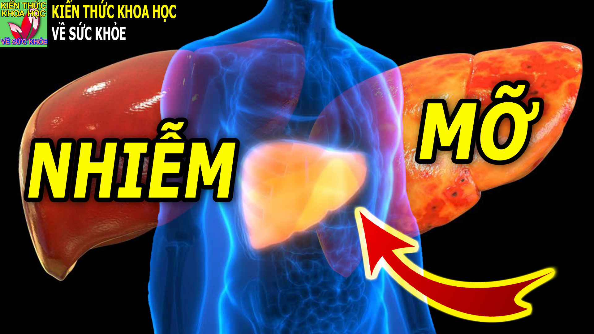 ban-ngay-co-trieu-chung-nay-coi-chung-bi-gan-nhiem-mo