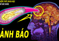 nguy-co-dot-quy-tang-gap-5-lan-neu-co-bieu-hien-nay