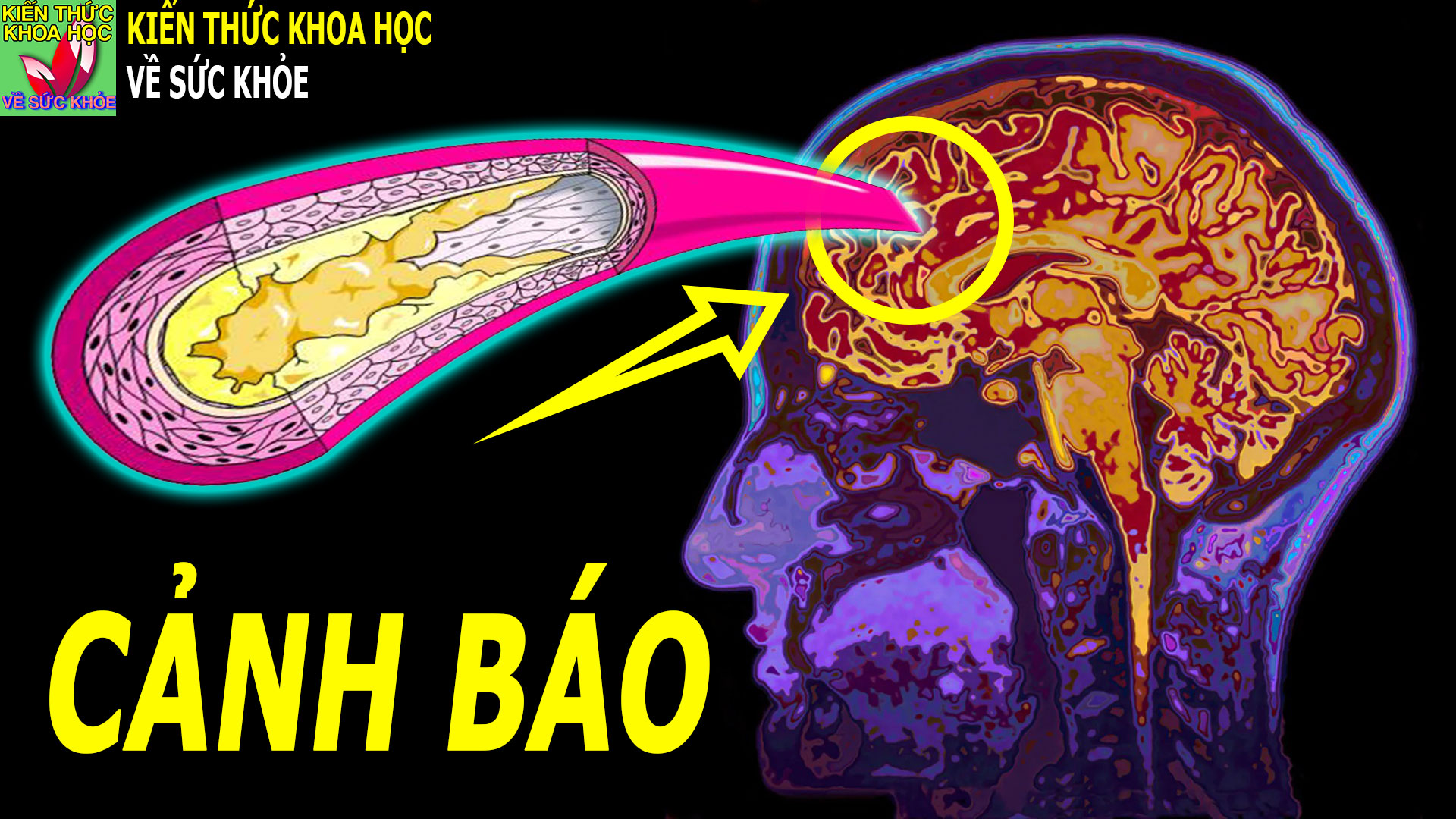 nguy-co-dot-quy-tang-gap-5-lan-neu-co-bieu-hien-nay