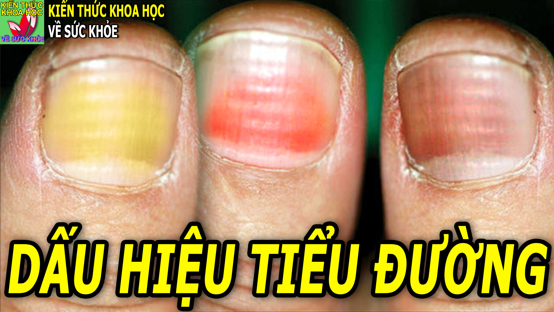 4-dau-hieu-o-mong-tay-co-the-canh-bao-som-benh-tieu-duong