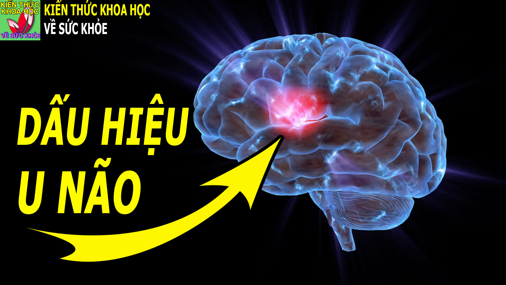 nhung-trieu-chung-canh-bao-benh-u-nao-ai-cung-nen-biet-som