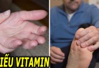 7-nhom-dau-hieu-canh-bao-co-the-ban-dang-bi-thieu-vitamin