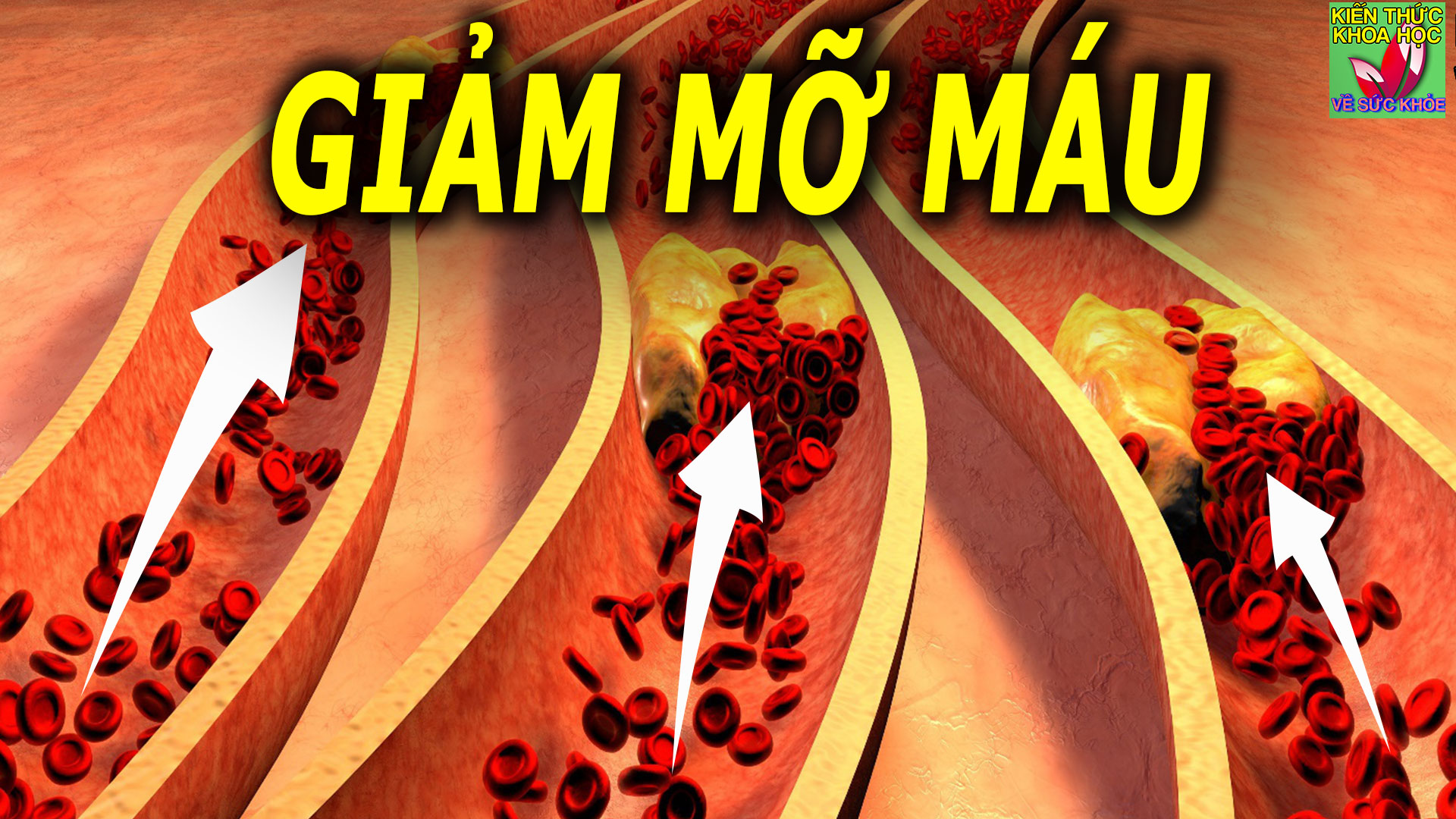 cach-giam-mo-mau-tu-nhien-chi-15-phut-moi-ngay