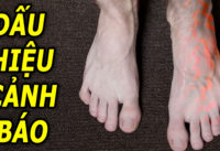 5-dau-hieu-tren-ban-chan-canh-bao-tinh-trang-suc-khoe