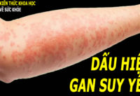 noi-me-day-co-the-lien-quan-den-chuc-nang-gan-suy-yeu