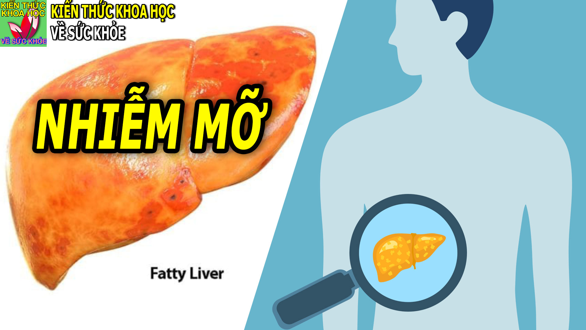 benh-gan-nhiem-mo-co-nguy-hiem-khong