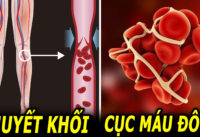 nhung-bieu-hien-cua-huyet-khoi-cuc-mau-dong