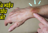 9-dau-hieu-canh-bao-o-nguoi-an-uong-thieu-chat