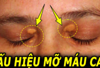 dau-hieu-bat-thuong-canh-bao-luong-mo-mau-tang-cao