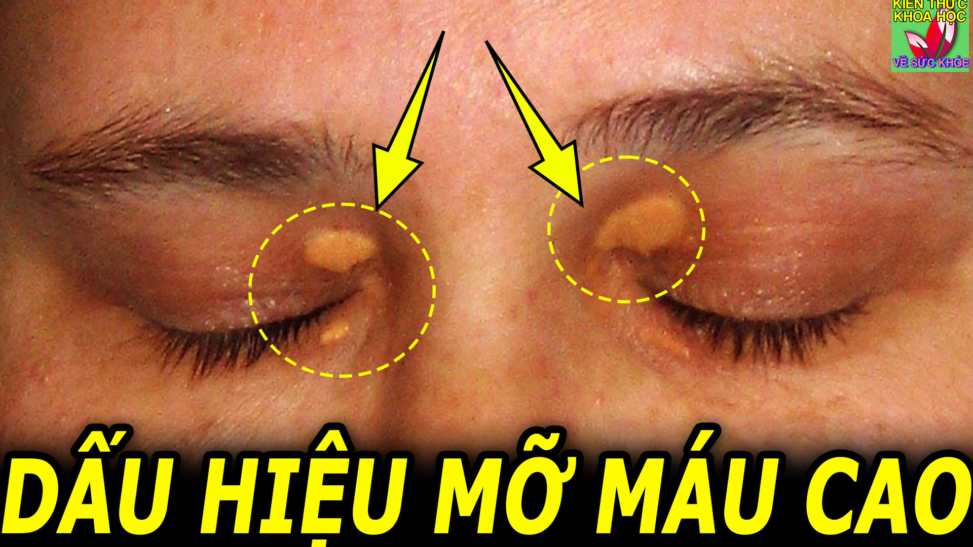 dau-hieu-bat-thuong-canh-bao-luong-mo-mau-tang-cao