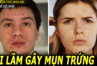 nguyen-nhan-bi-mun-trung-ca