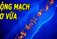 benh-xo-vua-dong-mach-la-gi