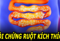 hoi-chung-ruot-kich-thich-nguyen-nhan-va-cach-phong-tri