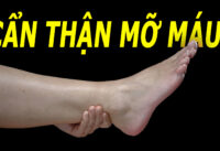 can-than-mo-mau-tang-cao-neu-co-4-dau-hieu-nay-o-ban-chan