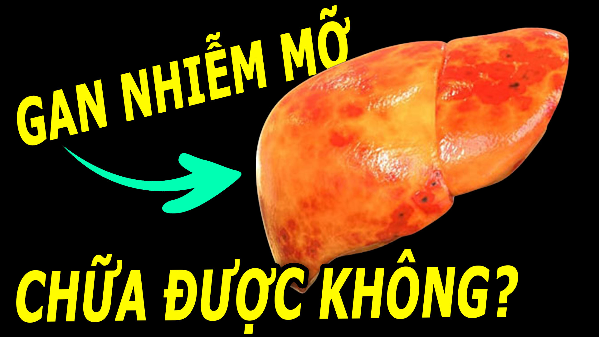 gan-nhiem-mo-co-chua-khoi-duoc-khong