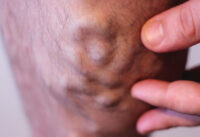 suy-gian-tinh-mach-chan-nen-lam-gi-de-cai-thien-tinh-hinh