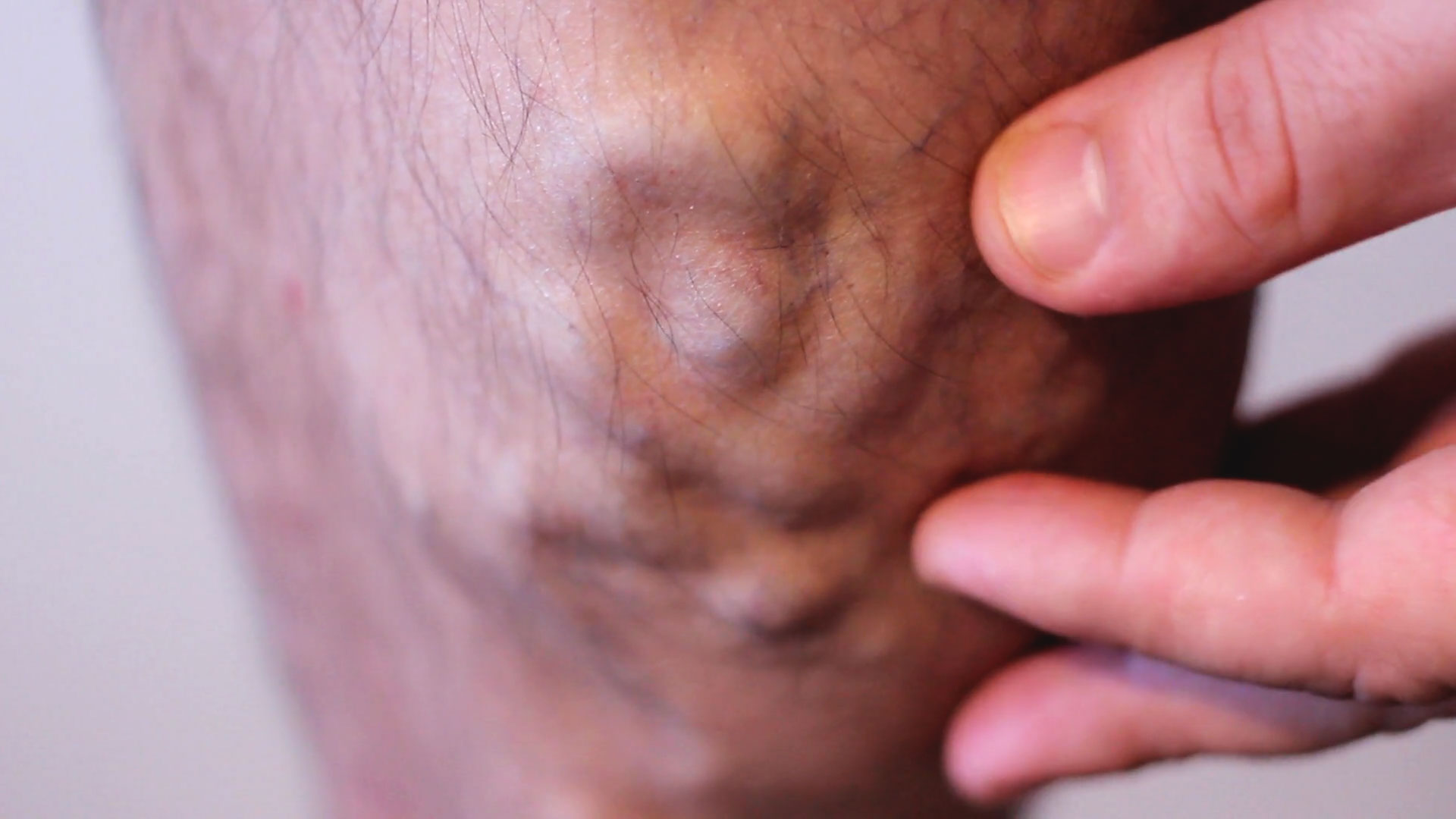 suy-gian-tinh-mach-chan-nen-lam-gi-de-cai-thien-tinh-hinh