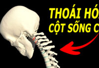 dau-hieu-thoai-hoa-cot-song-co-it-ai-ngo-den