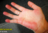 trieu-chung-tren-da-canh-bao-suc-khoe-cua-gan