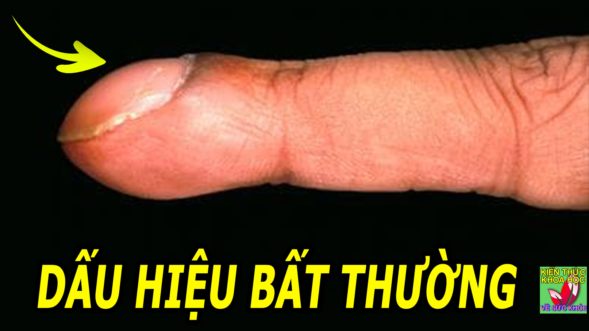 3-dau-hieu-bat-thuong-o-ngon-tay-giup-phat-hien-benh-ve-phoi
