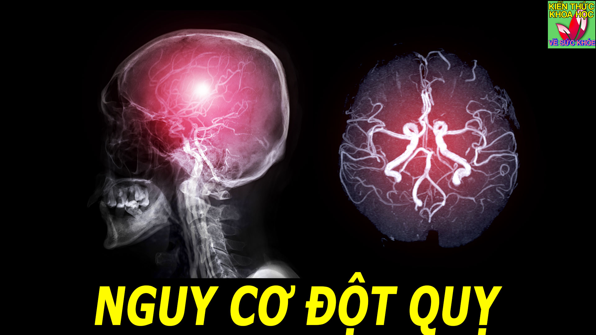 dau-hieu-canh-bao-dot-quy-cho-nen-chu-quan